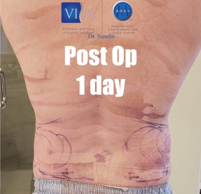 Liposuction Before & After Gallery - Patient 211876600 - Image 2