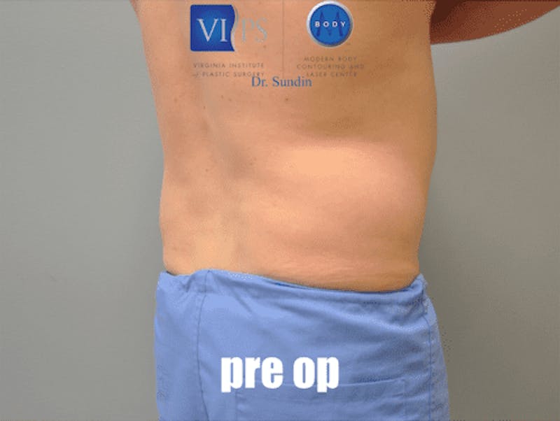 Renuvion J-Plasma Before & After Gallery - Patient 211876545 - Image 3