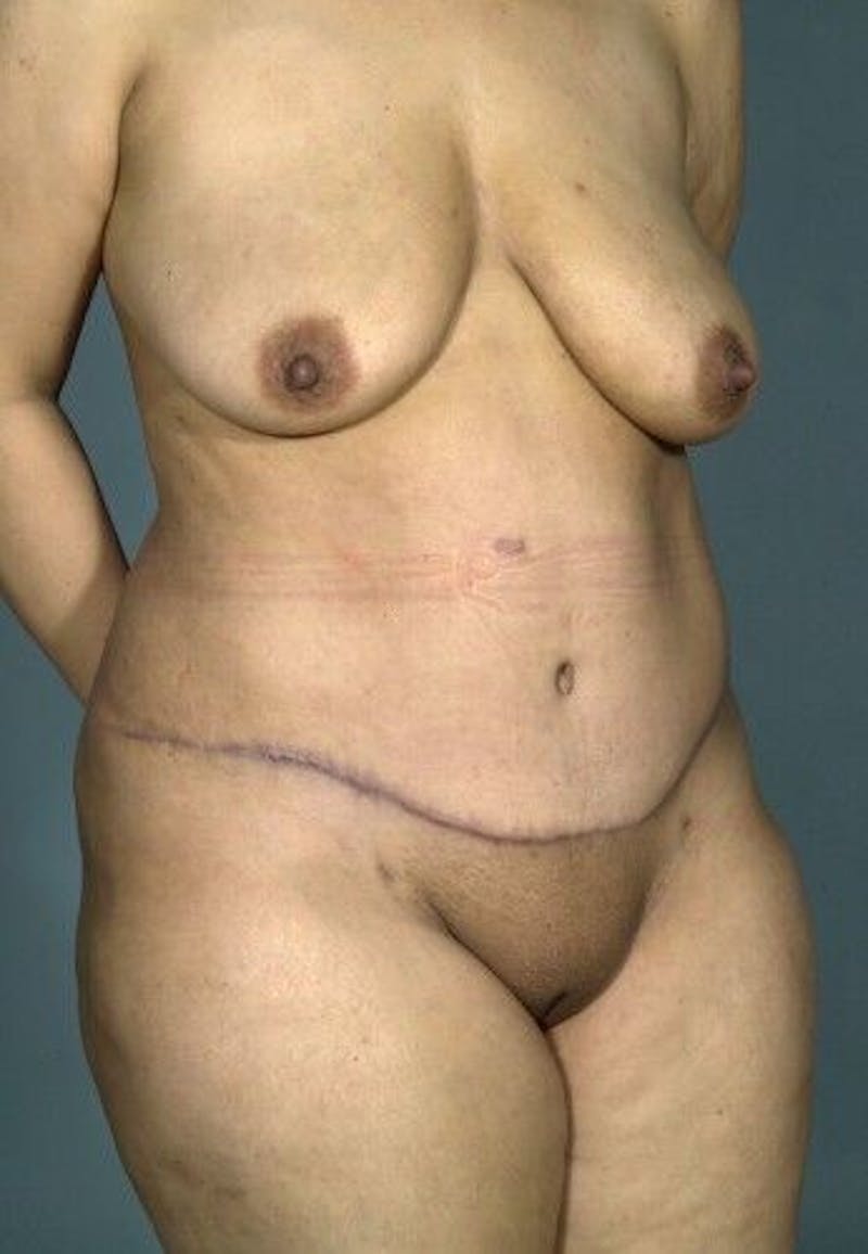 Tummy Tuck Before & After Gallery - Patient 55345434 - Image 4