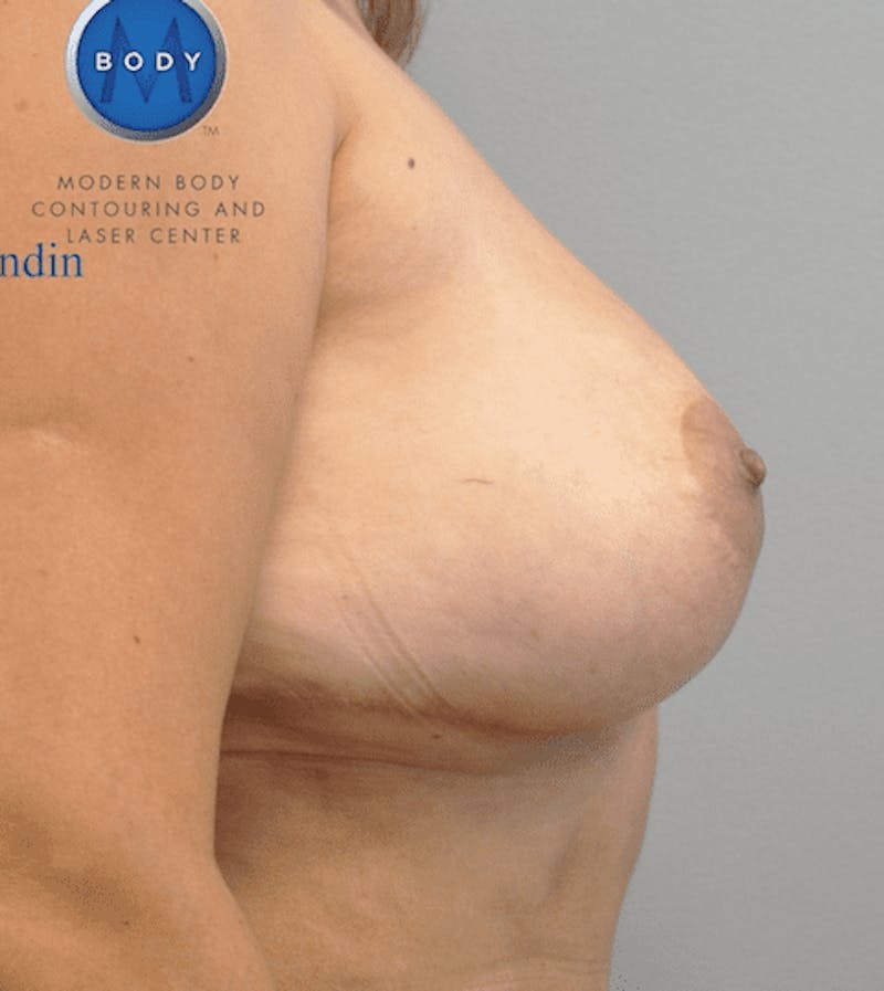 Implant Removal and Lift Before & After Gallery - Patient 55345433 - Image 4