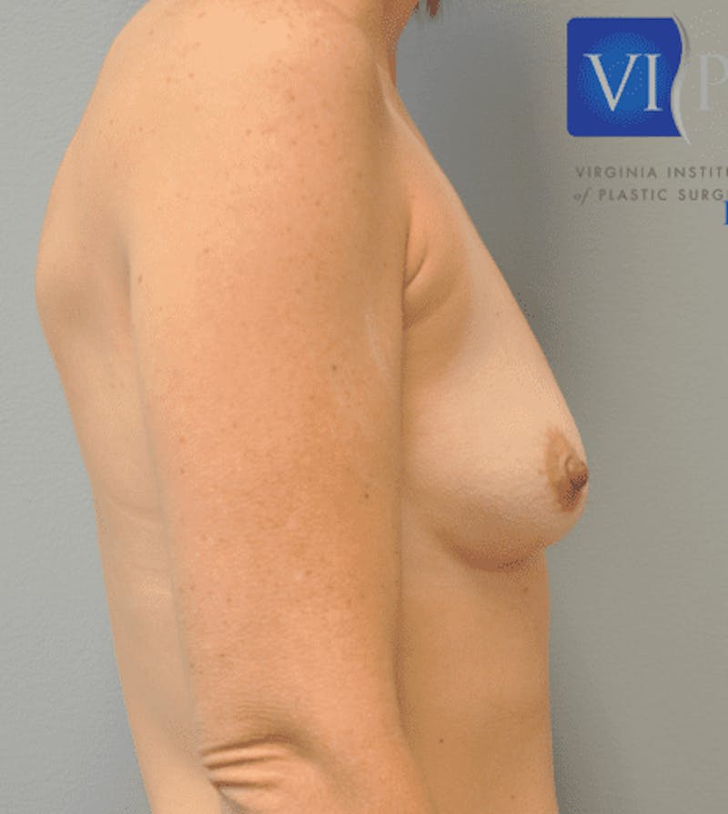 Breast Augmentation Before & After Gallery - Patient 55345439 - Image 5