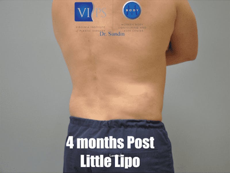 Liposuction Before & After Gallery - Patient 211876600 - Image 4