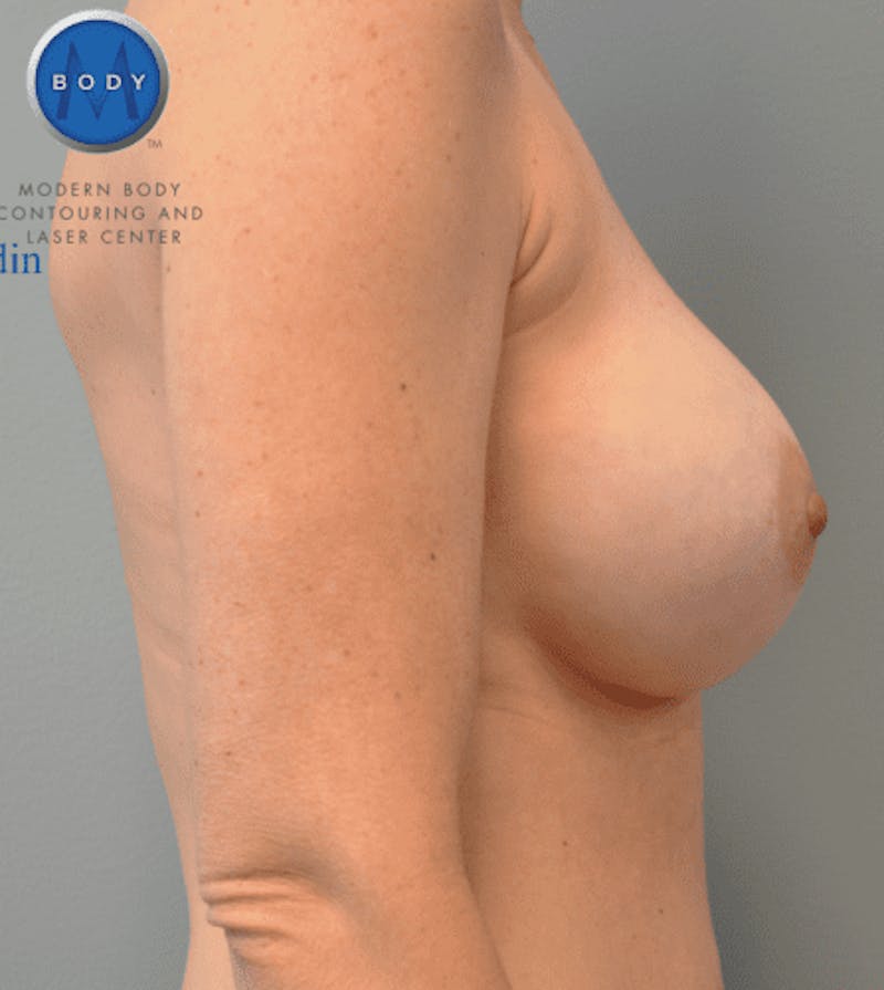 Breast Augmentation Before & After Gallery - Patient 55345439 - Image 6