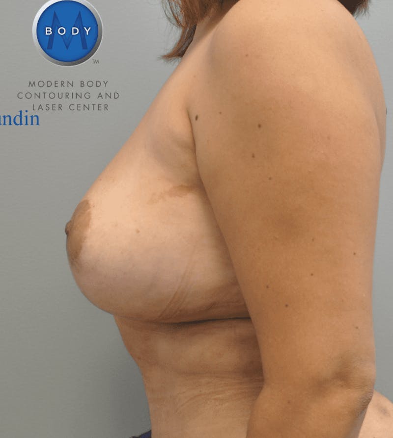Breast Revision Before & After Gallery - Patient 55345431 - Image 8