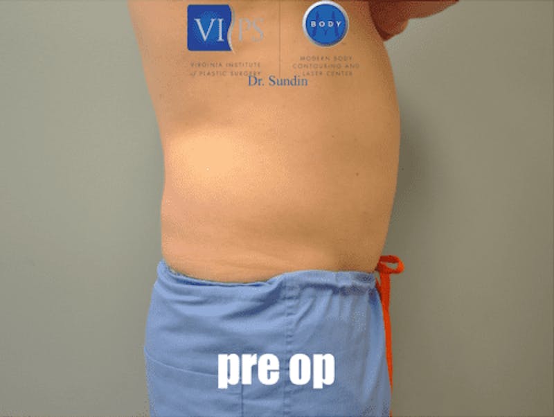 Liposuction Before & After Gallery - Patient 211876600 - Image 5