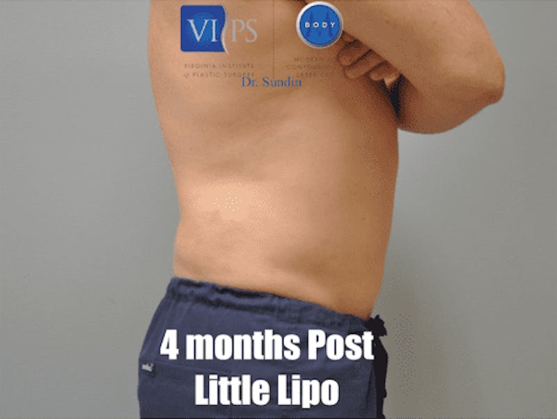 Liposuction Before & After Gallery - Patient 211876600 - Image 6