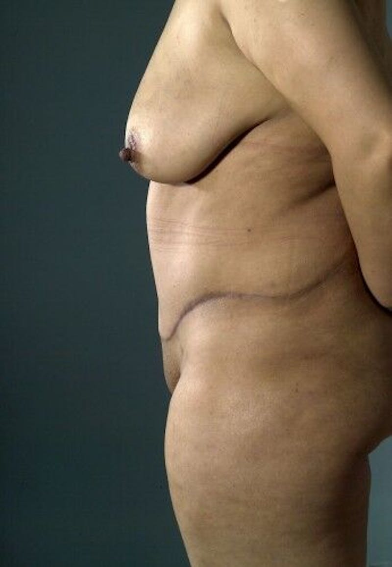 Tummy Tuck Before & After Gallery - Patient 55345434 - Image 8