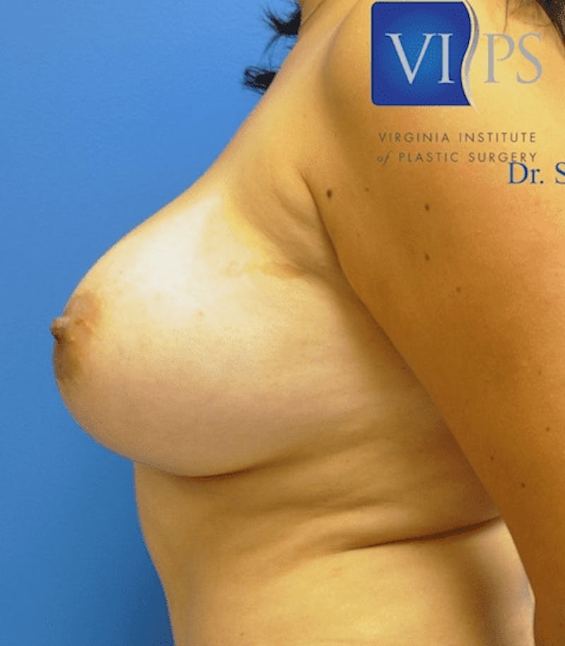 Implant Removal and Lift Before & After Gallery - Patient 55345433 - Image 7