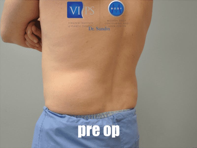Liposuction Before & After Gallery - Patient 211876600 - Image 7