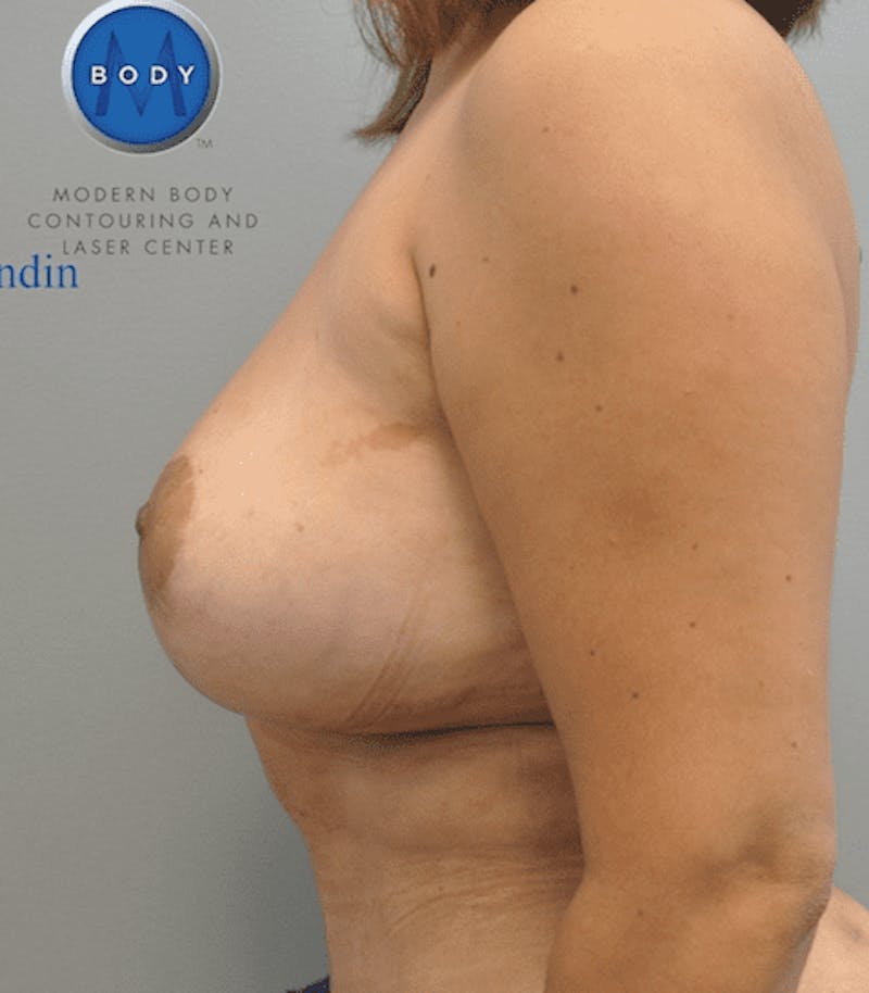 Implant Removal and Lift Before & After Gallery - Patient 55345433 - Image 8