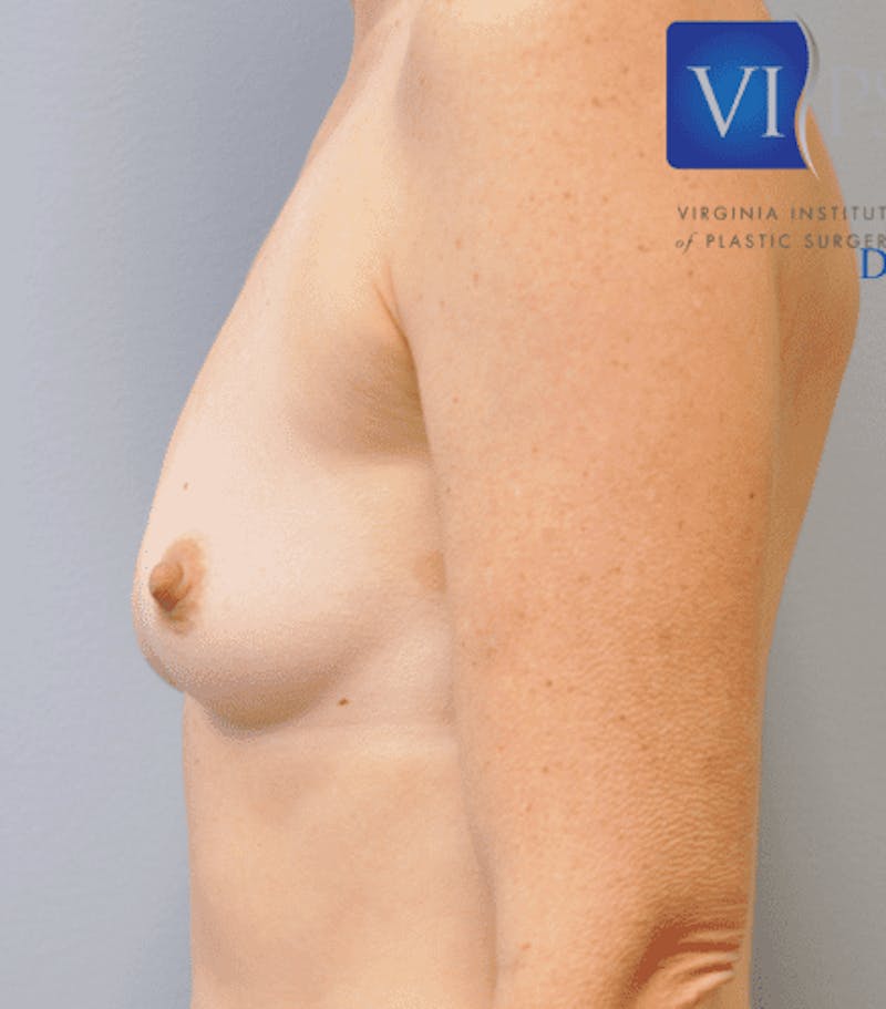 Breast Augmentation Before & After Gallery - Patient 55345439 - Image 9