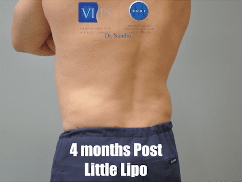 Liposuction Before & After Gallery - Patient 211876600 - Image 8