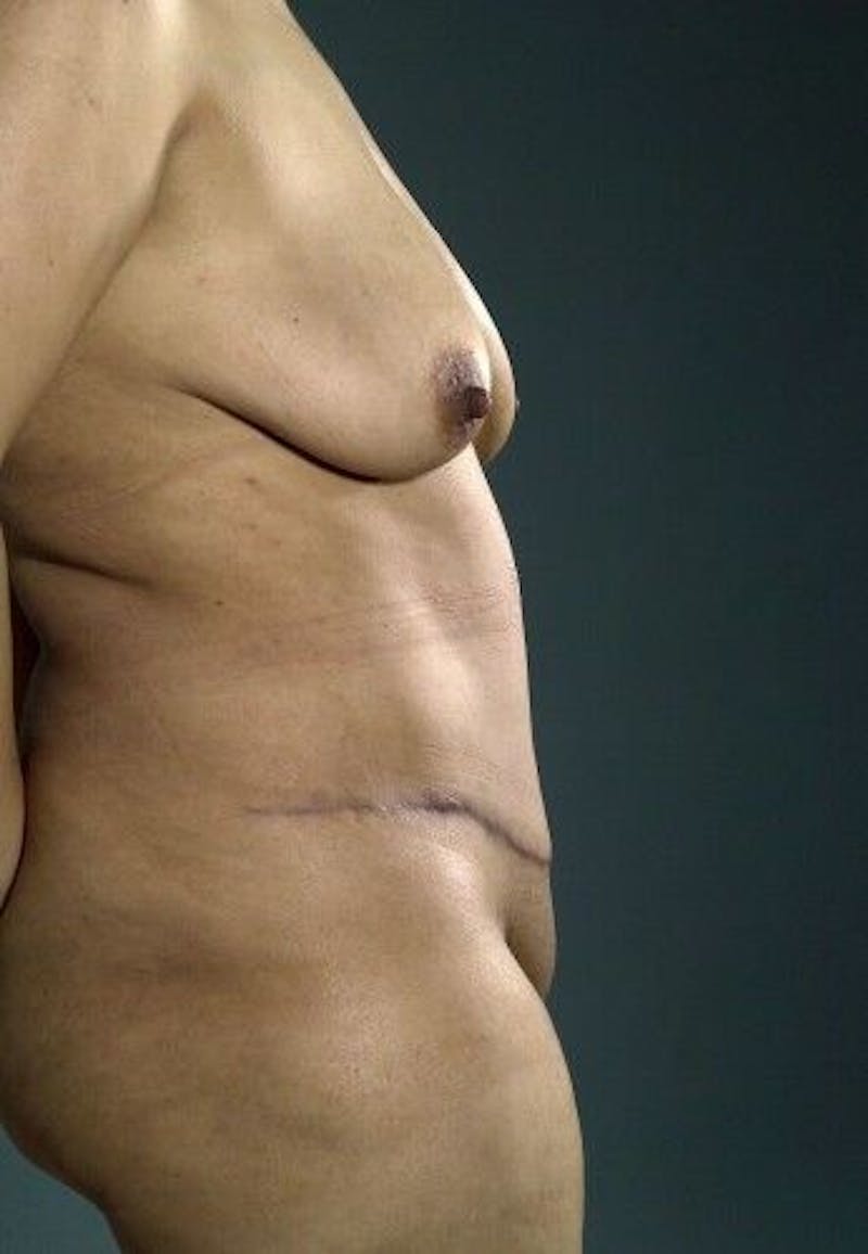 Tummy Tuck Before & After Gallery - Patient 55345434 - Image 10