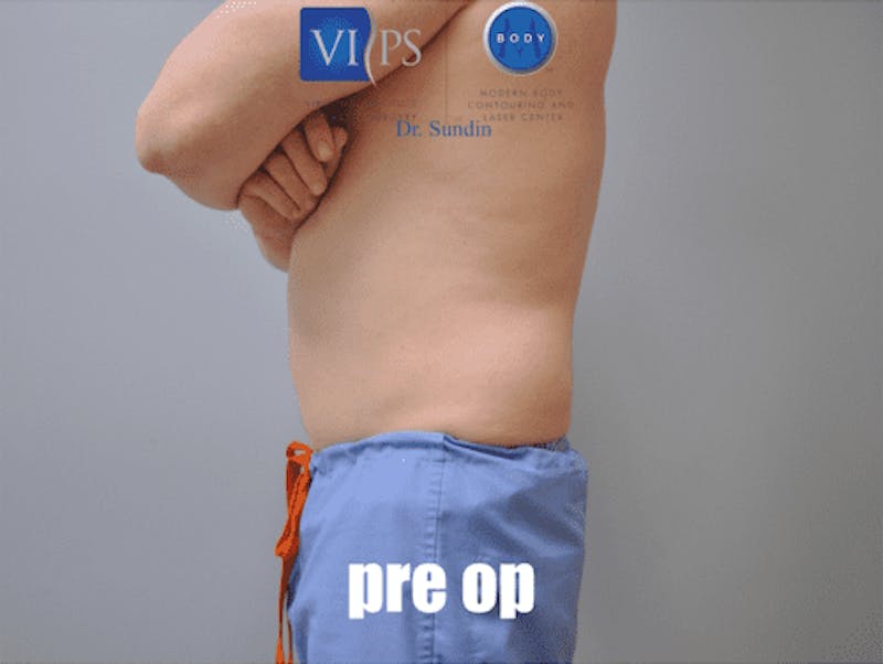 Liposuction Before & After Gallery - Patient 55345440 - Image 9
