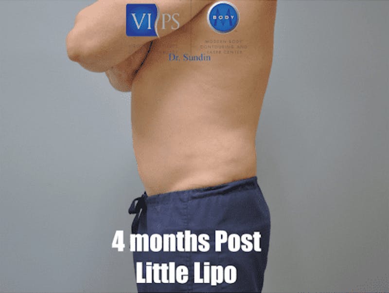 Liposuction Before & After Gallery - Patient 211876600 - Image 10