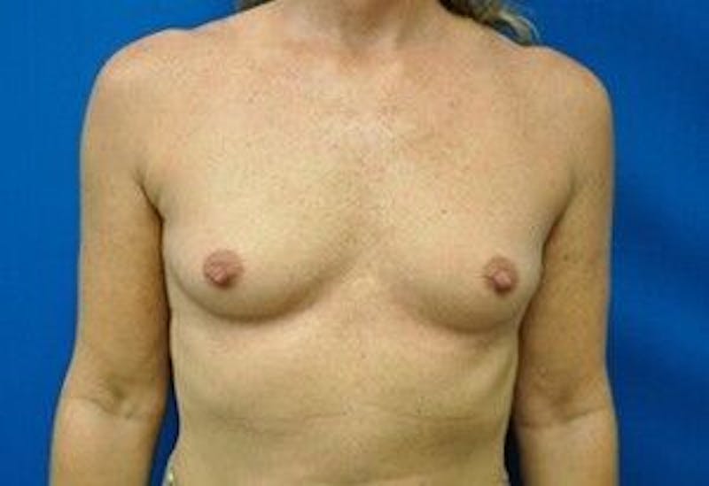 Breast Augmentation Before & After Gallery - Patient 55345547 - Image 1
