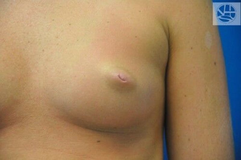 Nipple Eversion Before & After Gallery - Patient 55345541 - Image 1