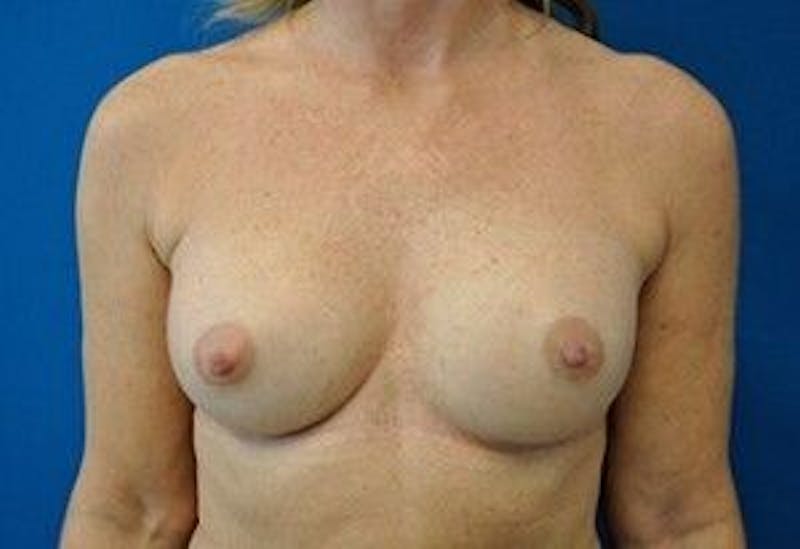 Breast Augmentation Gallery - Patient 55345547 - Image 2