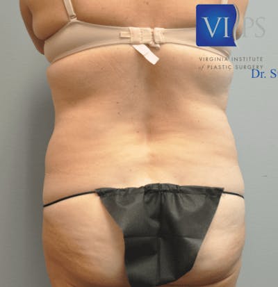 Liposuction Before & After Gallery - Patient 211876604 - Image 1