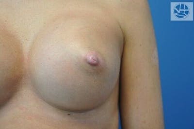Nipple Eversion Before & After Gallery - Patient 55345541 - Image 2
