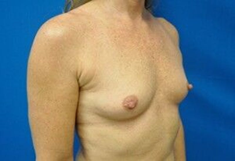 Breast Augmentation Before & After Gallery - Patient 55345547 - Image 3