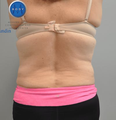 Renuvion J-Plasma Before & After Gallery - Patient 211876549 - Image 2