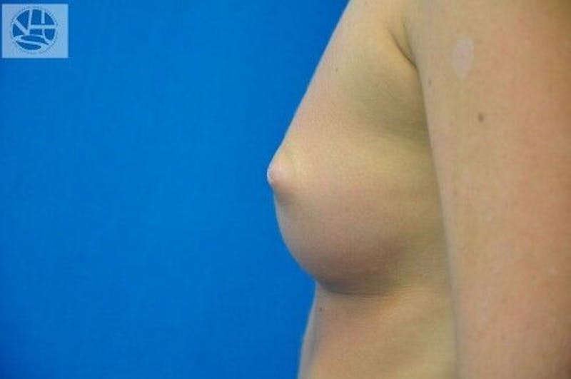 Nipple Eversion Before & After Gallery - Patient 55345541 - Image 3