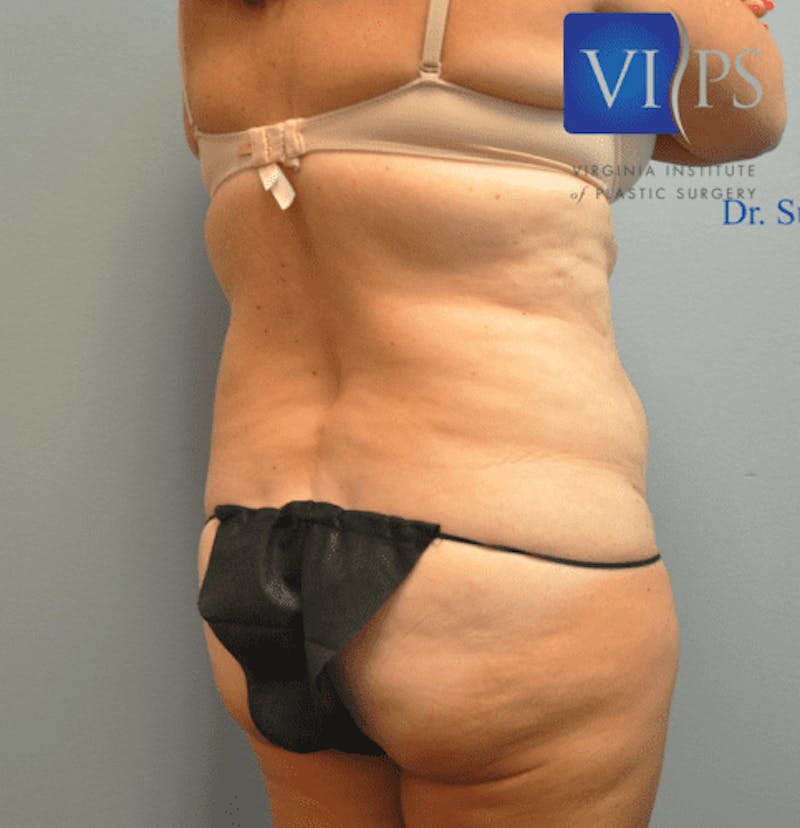 Liposuction Before & After Gallery - Patient 55345542 - Image 3