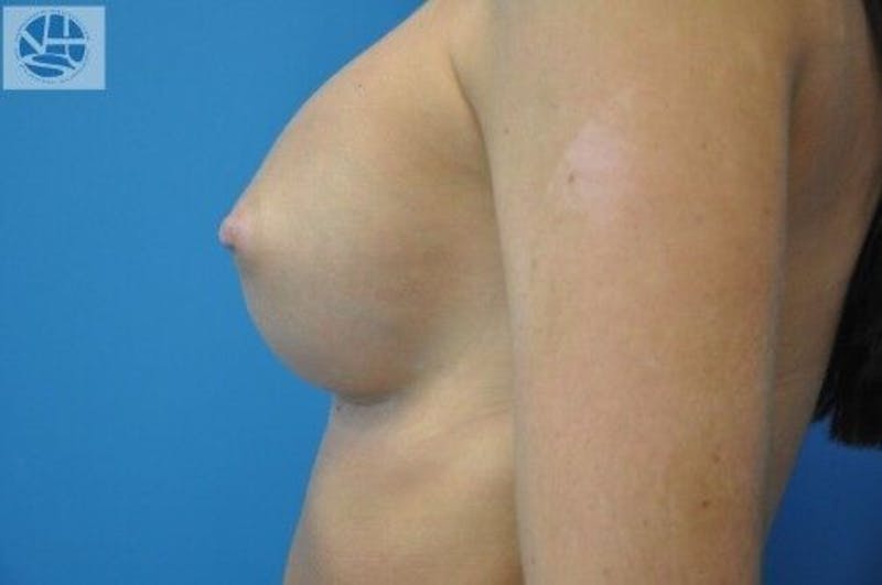 Nipple Eversion Before & After Gallery - Patient 55345541 - Image 4