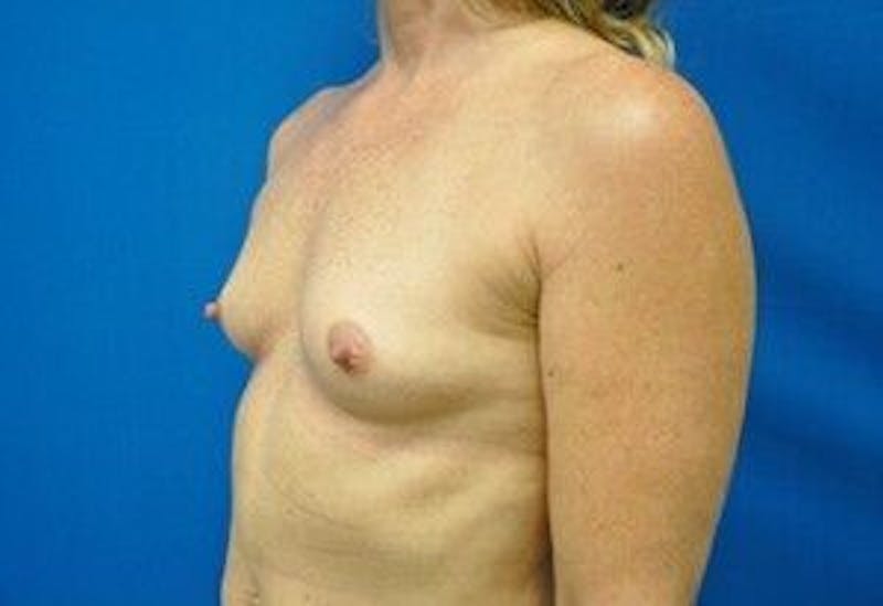 Breast Augmentation Before & After Gallery - Patient 55345547 - Image 5