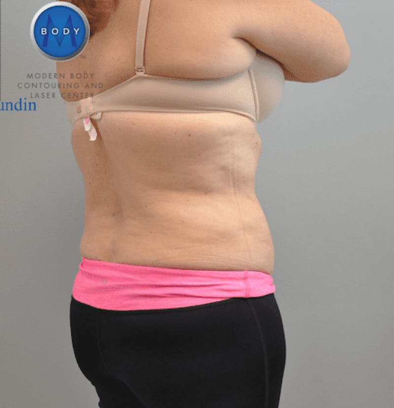Liposuction Before & After Gallery - Patient 55345542 - Image 4