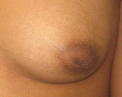 Nipple Eversion Gallery - Patient 55345549 - Image 1
