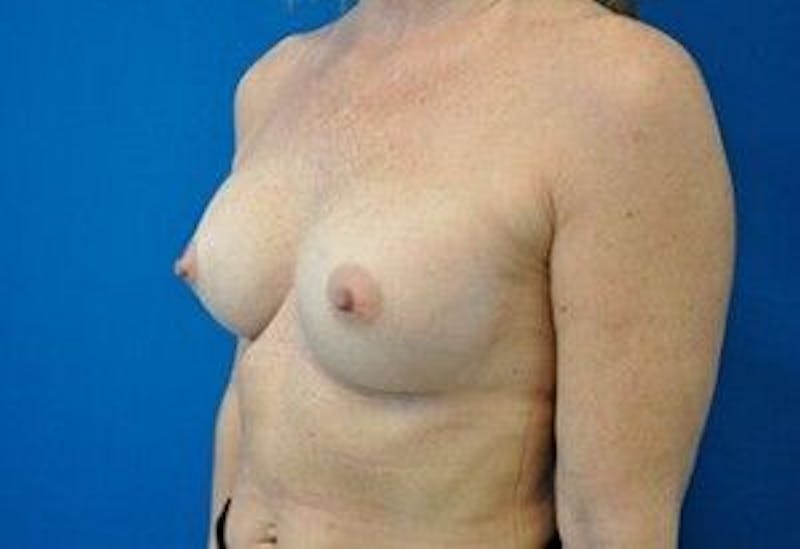 Breast Augmentation Before & After Gallery - Patient 55345547 - Image 6