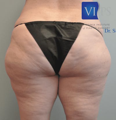Liposuction Before & After Gallery - Patient 211876605 - Image 1