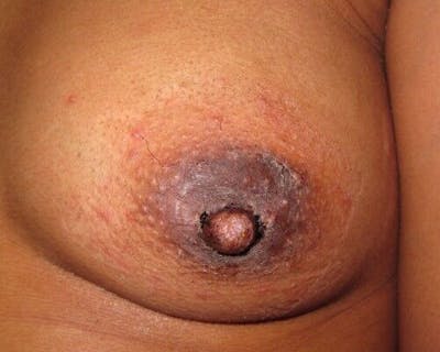 Nipple Eversion Gallery - Patient 55345549 - Image 2