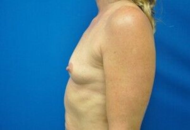 Breast Augmentation Before & After Gallery - Patient 55345547 - Image 7