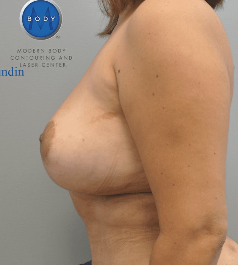 Breast Revision Before & After Gallery - Patient 55345548 - Image 8