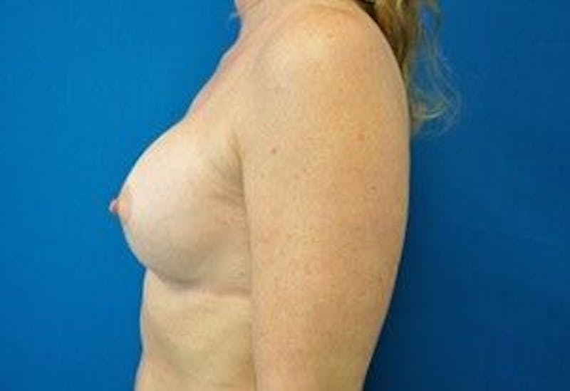 Breast Augmentation Gallery - Patient 55345547 - Image 8