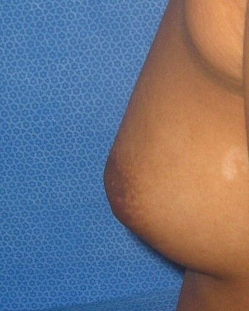 Nipple Eversion Before & After Gallery - Patient 55345549 - Image 3