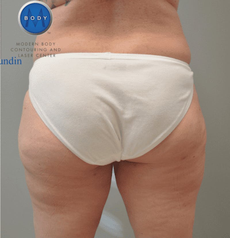 Liposuction Before & After Gallery - Patient 55345553 - Image 2