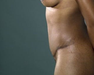Tummy Tuck Before & After Gallery - Patient 55345550 - Image 8