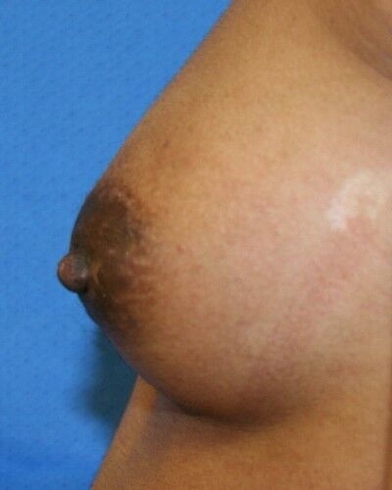 Nipple Eversion Before & After Gallery - Patient 55345549 - Image 4