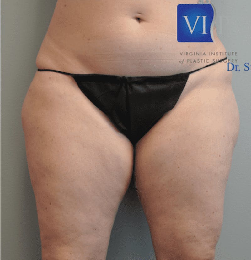 Renuvion J-Plasma Before & After Gallery - Patient 211876550 - Image 3