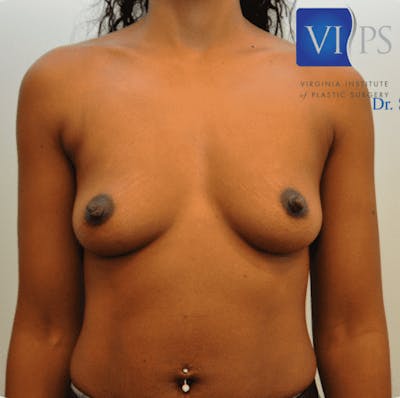 Breast Augmentation Before & After Gallery - Patient 55345557 - Image 1
