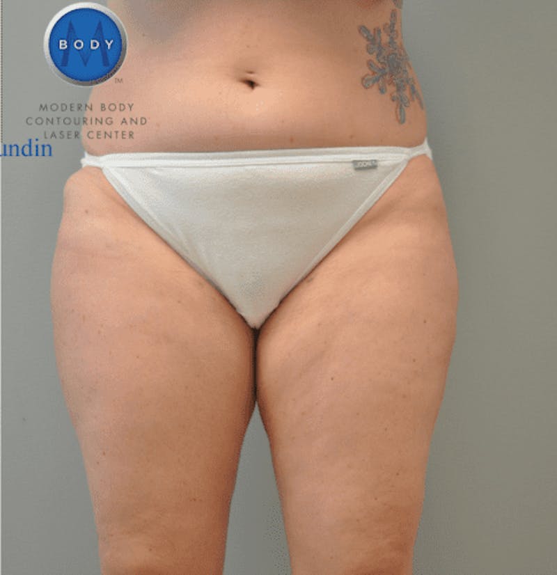 Liposuction Before & After Gallery - Patient 55345553 - Image 4