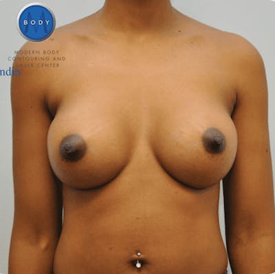Breast Augmentation Before & After Gallery - Patient 55345557 - Image 2