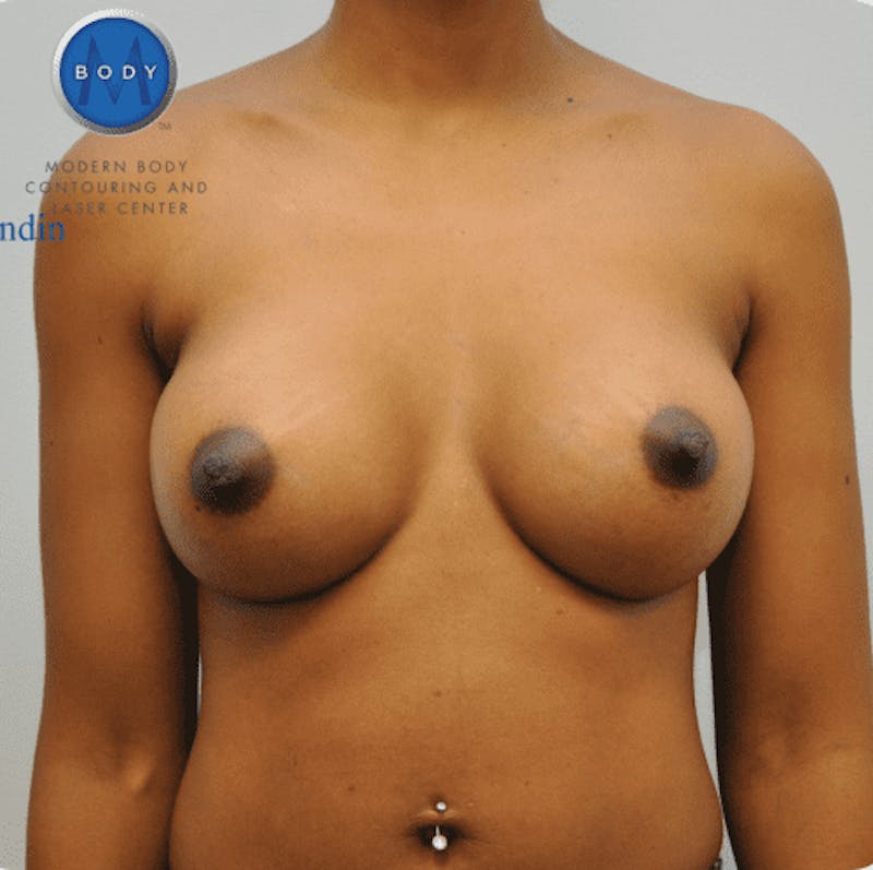 Breast Augmentation Before & After Gallery - Patient 55345557 - Image 2