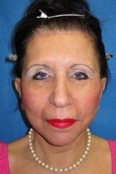 Browlift Before & After Gallery - Patient 55345552 - Image 2