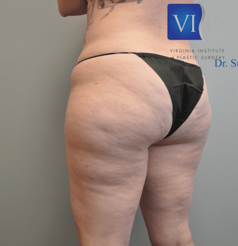 Renuvion J-Plasma Before & After Gallery - Patient 211876550 - Image 5