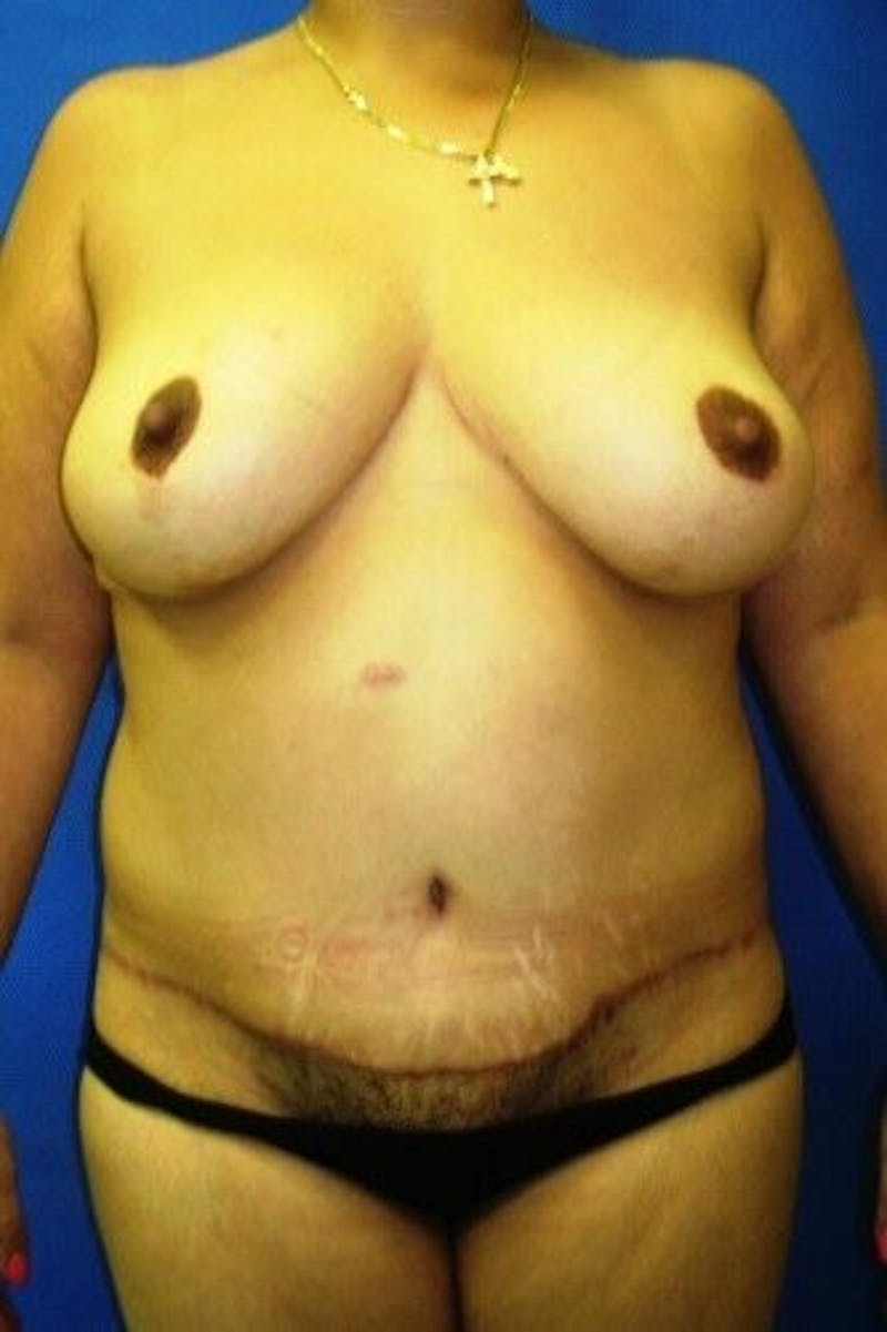 Tummy Tuck Before & After Gallery - Patient 55345554 - Image 2